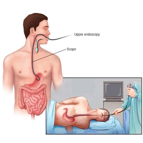 New research reveals devastating impact of COVID-19 on the diagnosis of oesophageal and stomach cancer